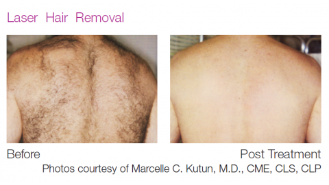 mens hair removal